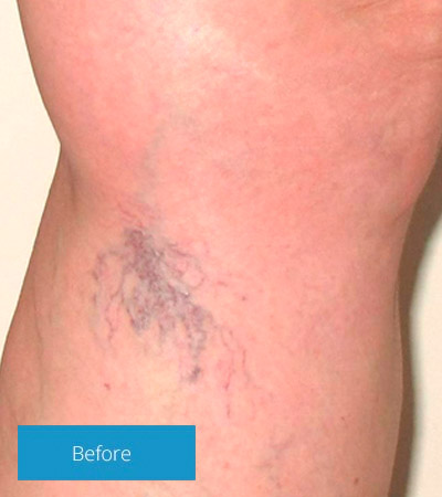 5 Simple Makeups To Cover Varicose Veins Spider Veins