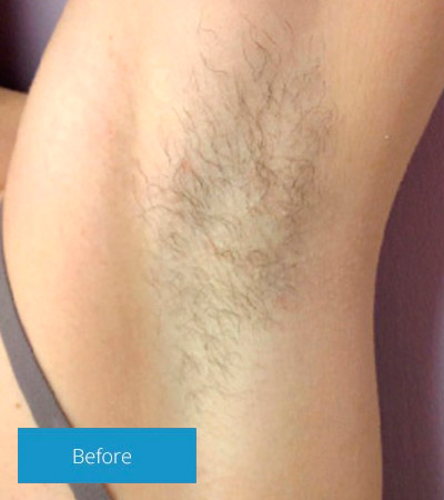Kelowna Laser Hair Removal (excess hair) - Serenity Aesthetics Skin Care